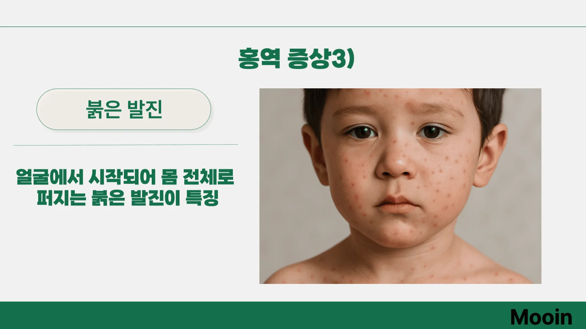 홍역 증상3)