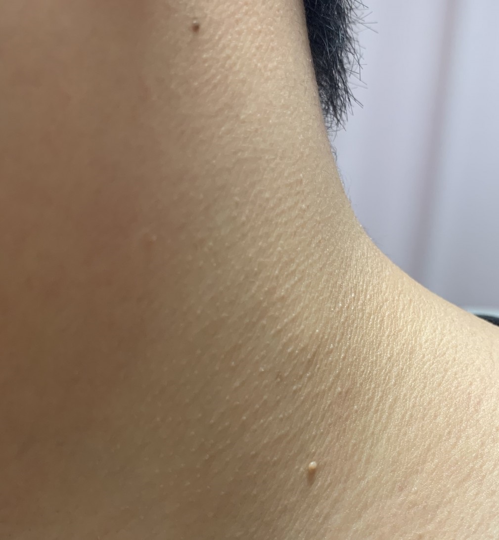 쥐젖이 나타난 사진