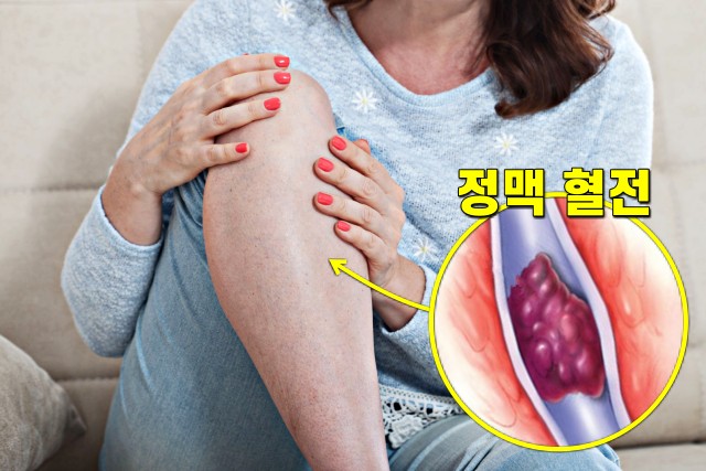 혈전 생기면 나타나는 이상 증상 7, 팔 다리 붓기 통증