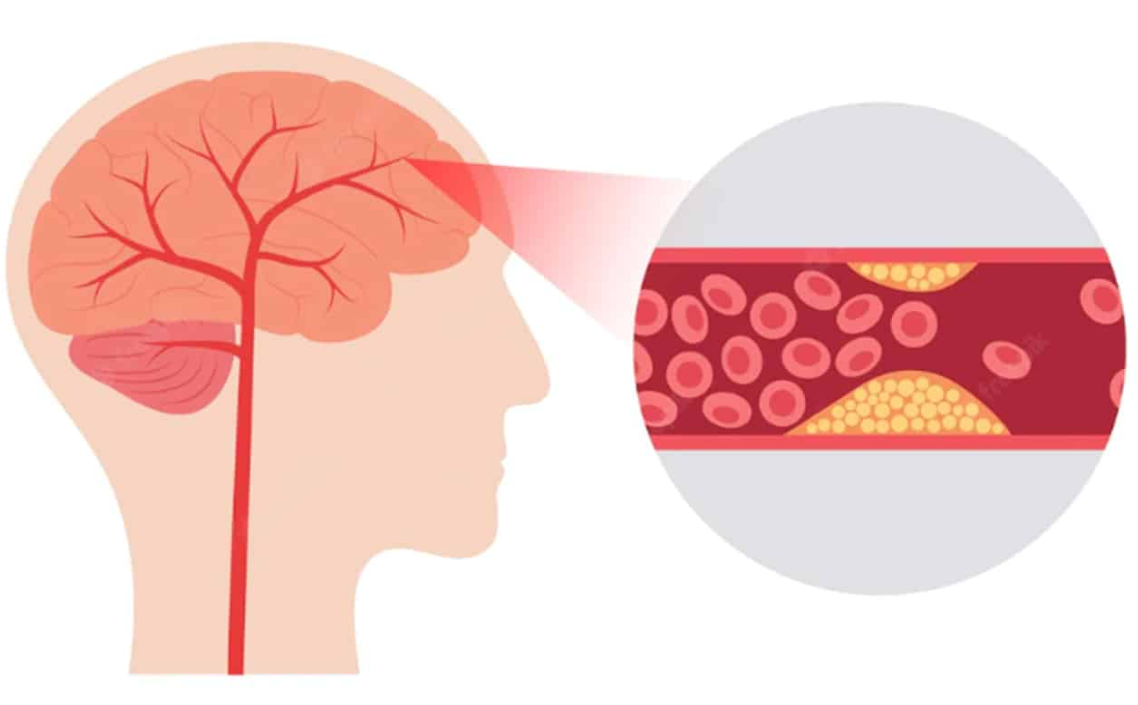 두뇌의 혈관에 혈전이 쌓여 혈관이 막힌다