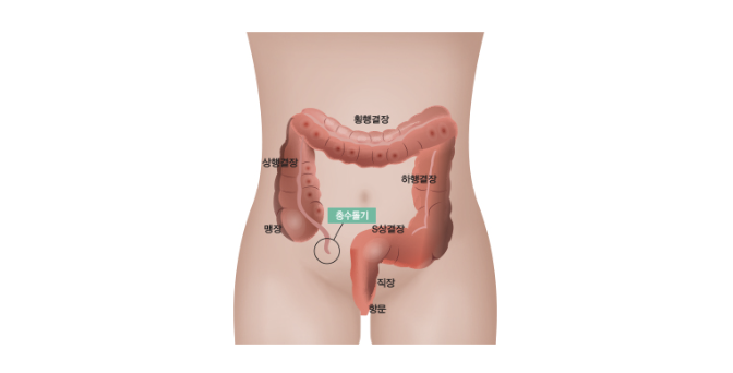 맹장과 충수돌기 위치 이미지