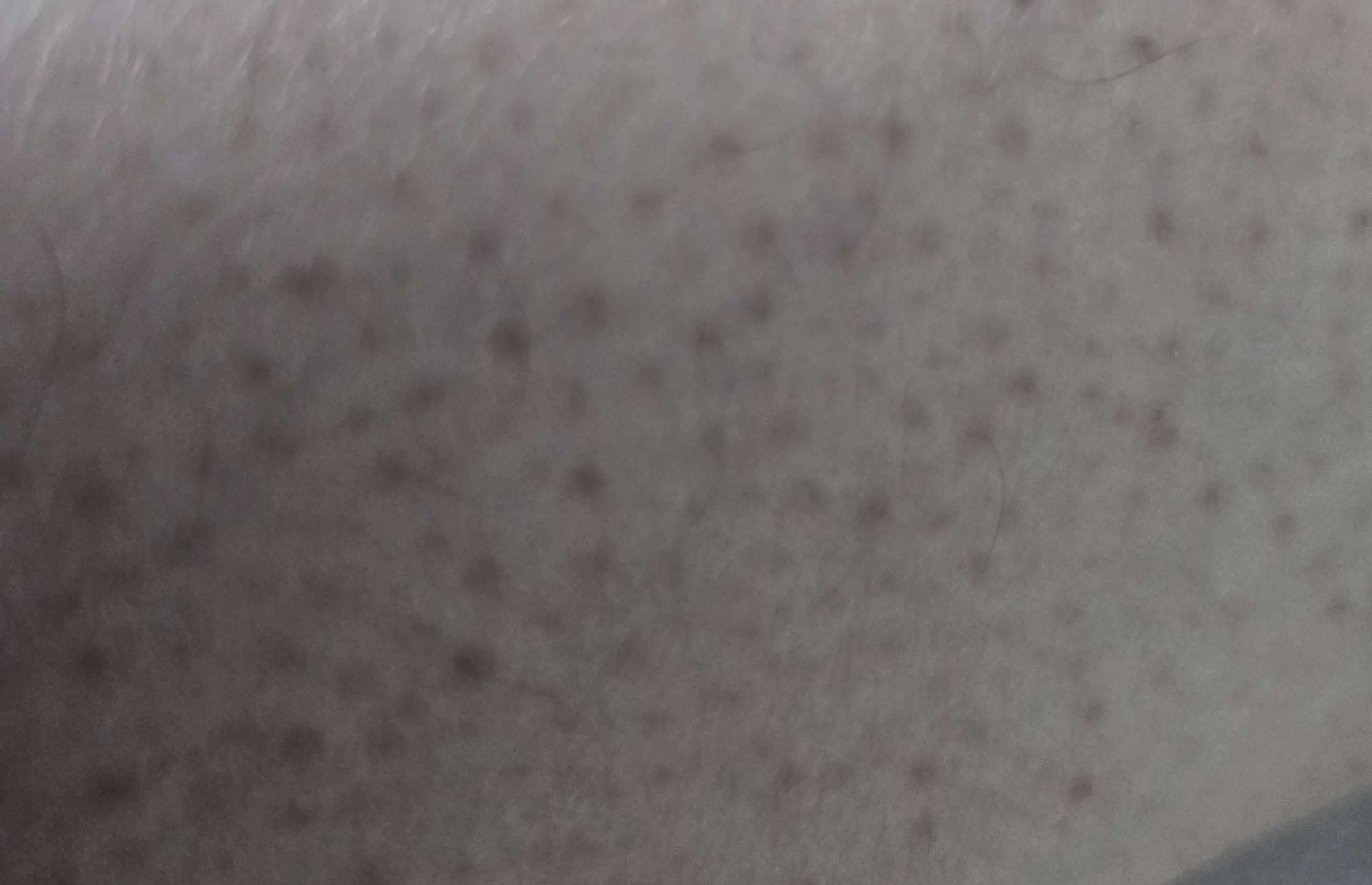 팔 피부에 모공각화증처럼 보이는 오돌토돌한 붉은 점과 거친 피부결이 가까이 촬영된 모습