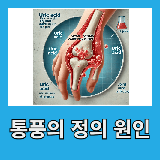통풍의 정의와 원인
