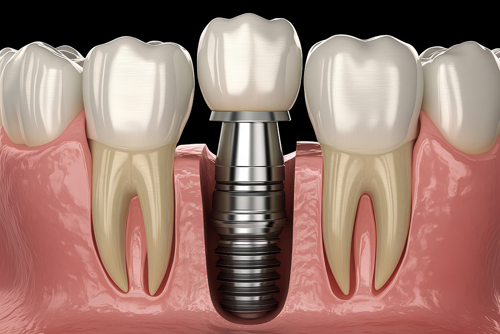 임플란트 의료보험적용대상