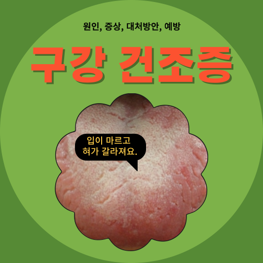 구함증&#44; 구고증&#44; 구강건조증&#44; 구강작열감증후군: 이들의 원인과 증상을 파헤쳐보자