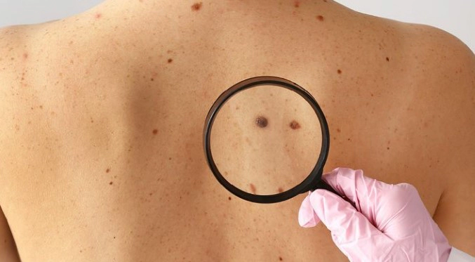 흑색종 치료법과 예후