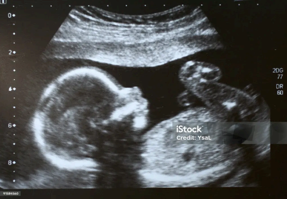 다운증후군(Trisomy 21) 완전정리 &mdash; 산전검사&middot;확진&middot;관리까지Down syndrome