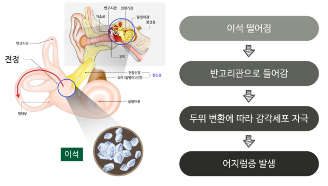 이석증 원인