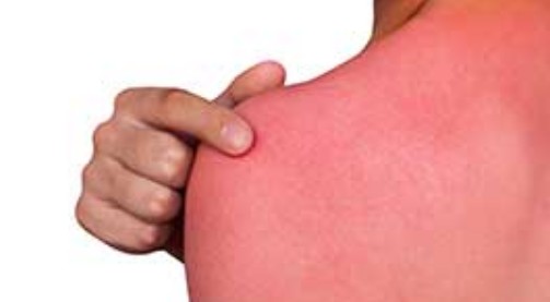 일광화상 물집, 일광화상 가려움 완화 / 일광화상 예방법