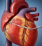부정맥 치료방법