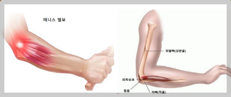 테니스엘보