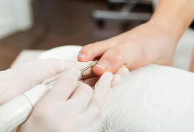 무좀 증상별 무좀약 추천