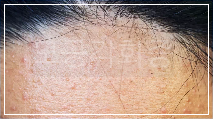 얼굴 모공각화증