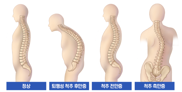 척추-측만증-전만증-후만증