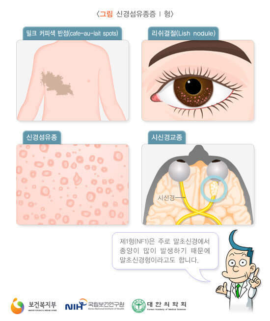 신경섬유종증 I 형