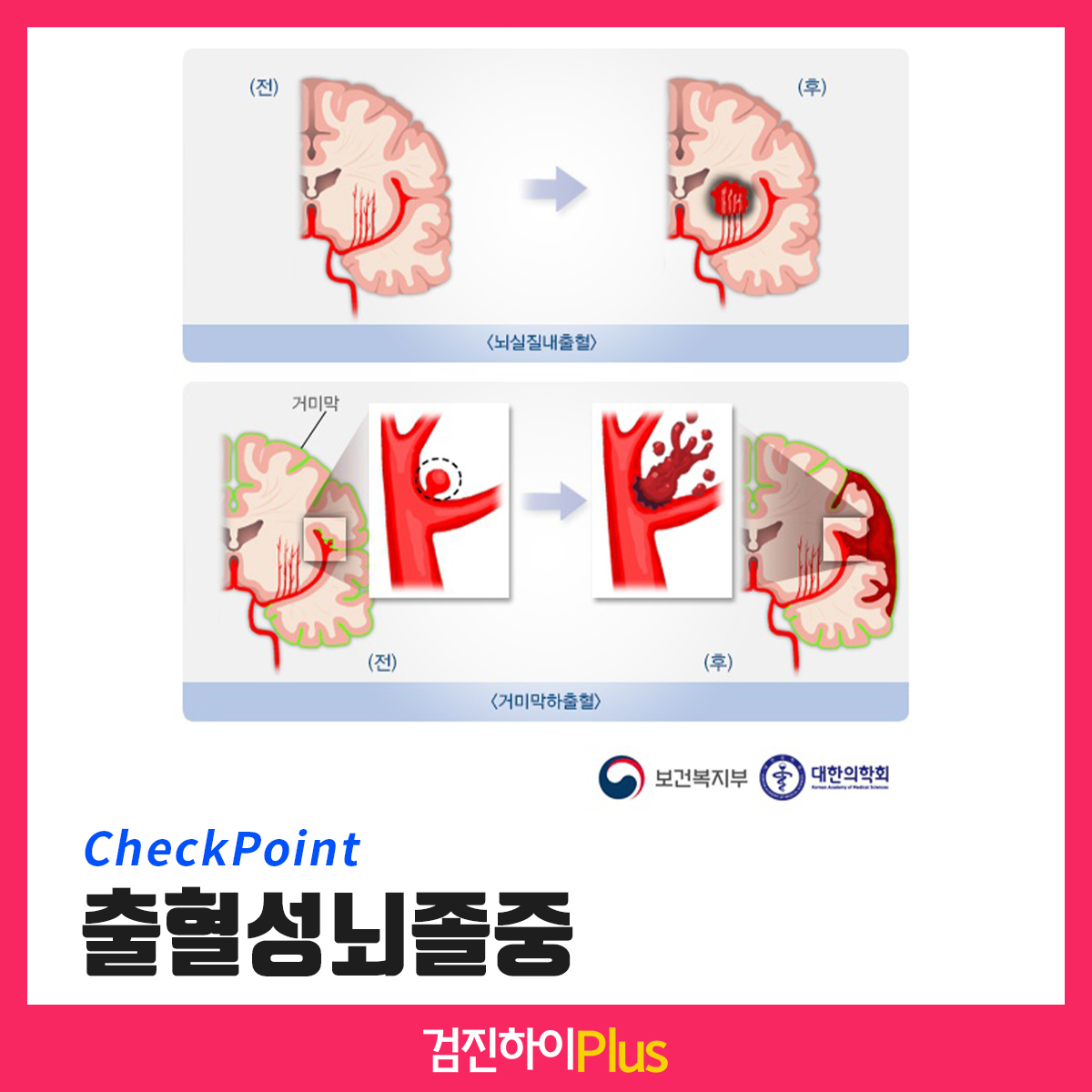 뇌졸중