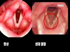 성대결절