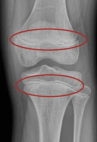 성장판 닫혀도 키 클 수 있는 방법과 성장 호르몬 시기_4