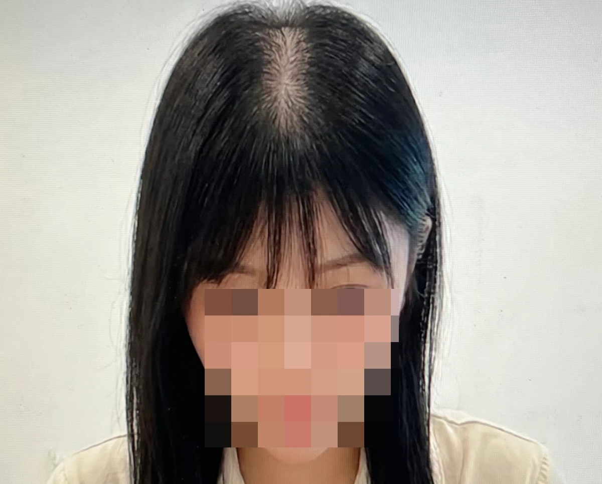 함익병-탈모크림-바르기-전-사진