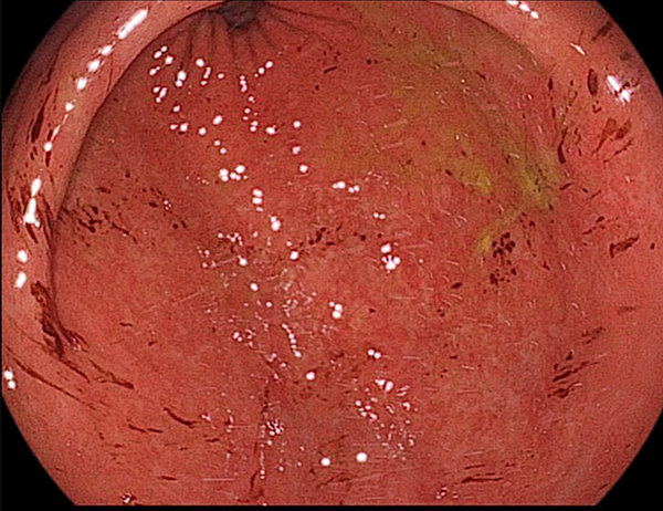 출혈성위염2_출처:EndoToday
