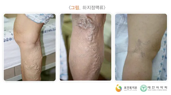 하지 정맥류 증상 치료방법과 예방 생활습관_9