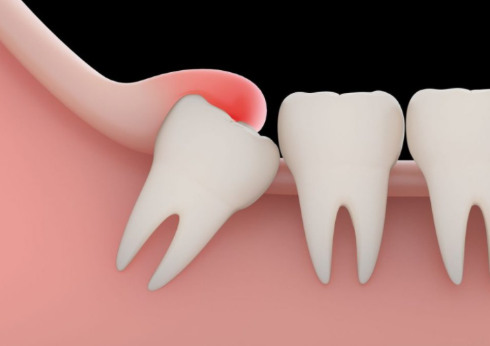 매복사랑니 발치