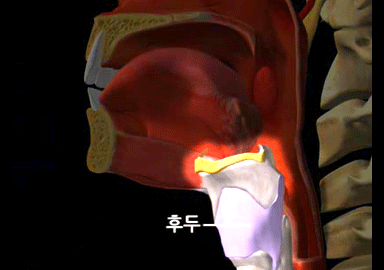 후두암 초기증상,후두암증세,후두암 원인 및 후두암 예방법,후두암치료 방법
