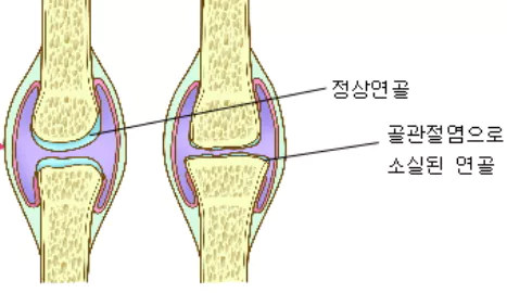 무릎-관절염에-좋은-운동-주의사항