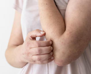 스테로이드 부작용 13