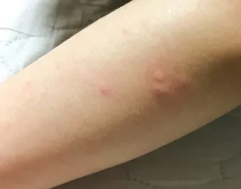 침구 진드기 햇볕 건조와 고온 살균 보관법_4