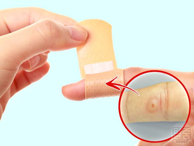 손가락 사마귀 제거 연고