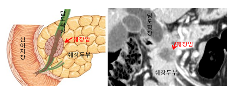 췌장암
