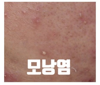 모낭염 증상