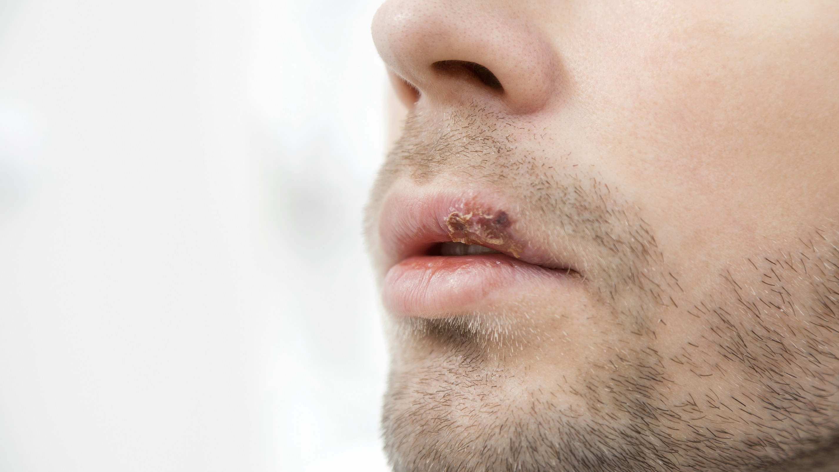 입술 헤르페스 증상