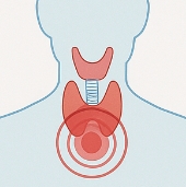갑상선암 증상