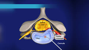 목디스크 치료방법
