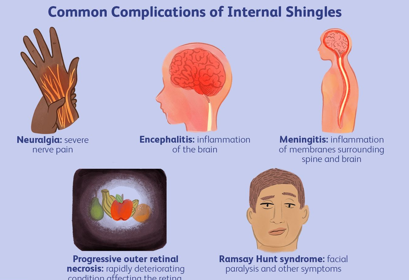 대상 포진의 원인