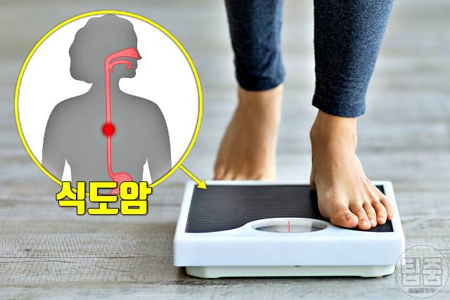 식도암 증상 식도암초기증상 체중감소