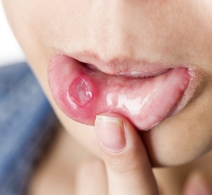구내염 빨리 낫는 법