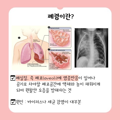호흡기 질환 :폐렴- 증상, 원인, 전염성, 예방접종, 예방법.