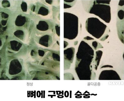골다공증 주사 치료