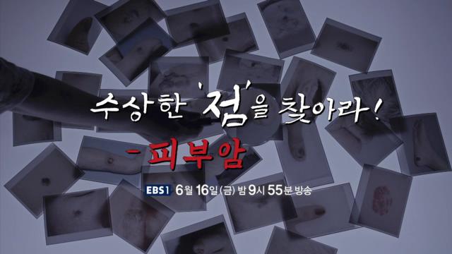 명의 수상한 '점'을 찾아라, 피부암, 악성 흑색종, 예방, 치료 방법