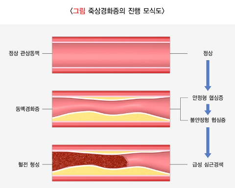 협심증 초기증상 2