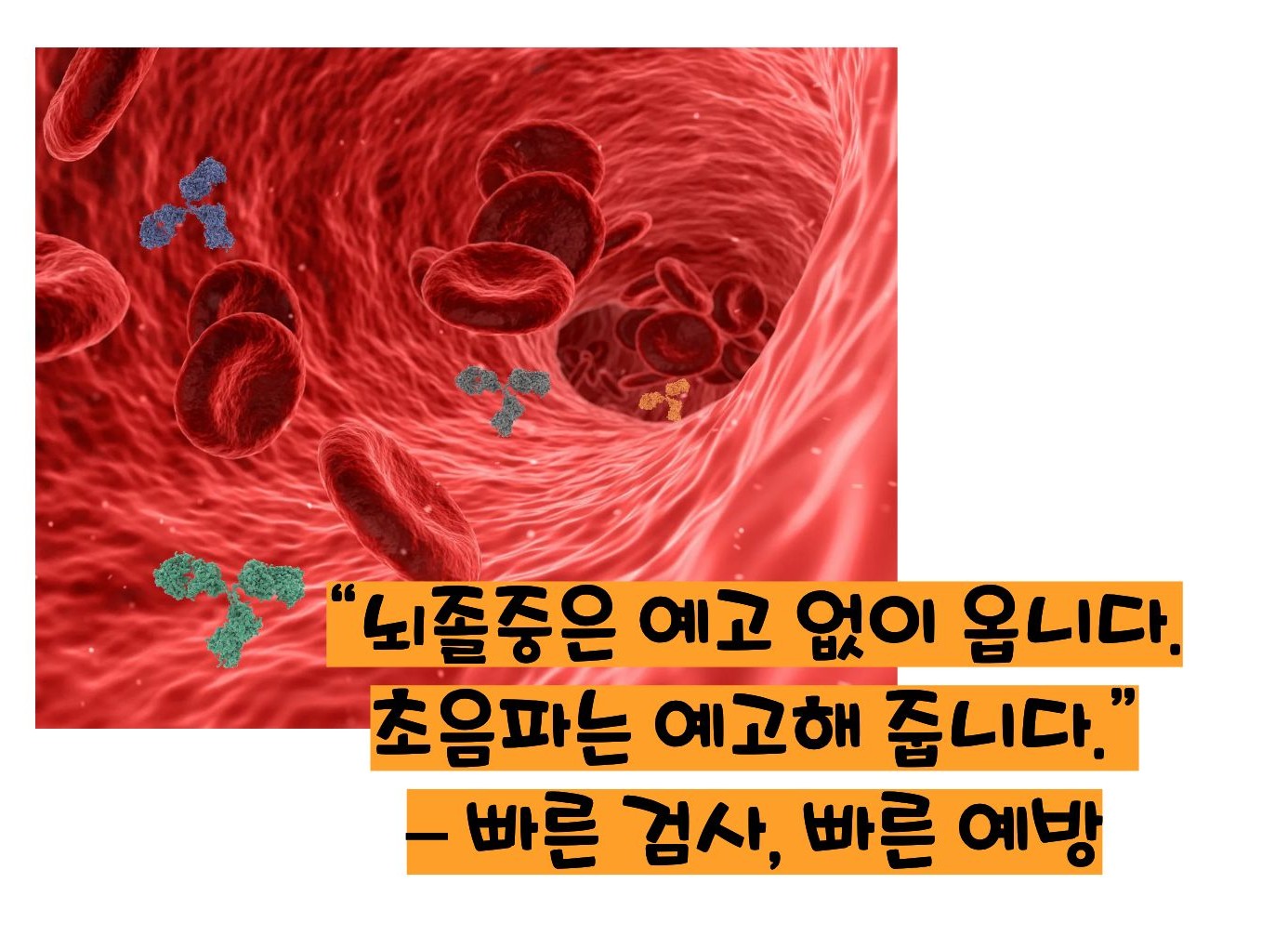 경동맥 초음파 검사로 알수 있는병의 설명