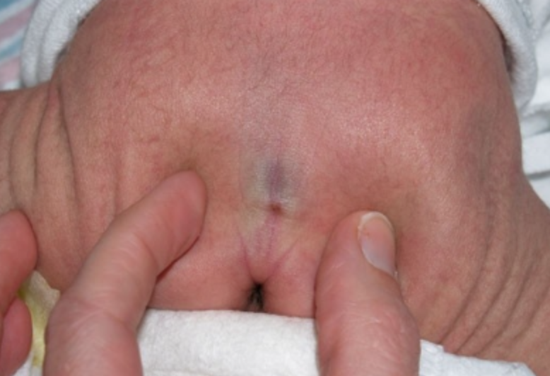 정상 딤플과 이상 징후 구분법