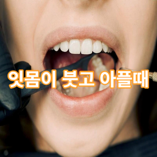 잇몸이-붓고-아플때-이유-해결방법-건강