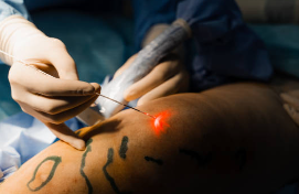 헤이저 정맥 폐쇄술