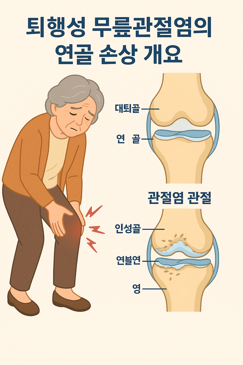 퇴행성 무릎관절염 연골 손상 개요