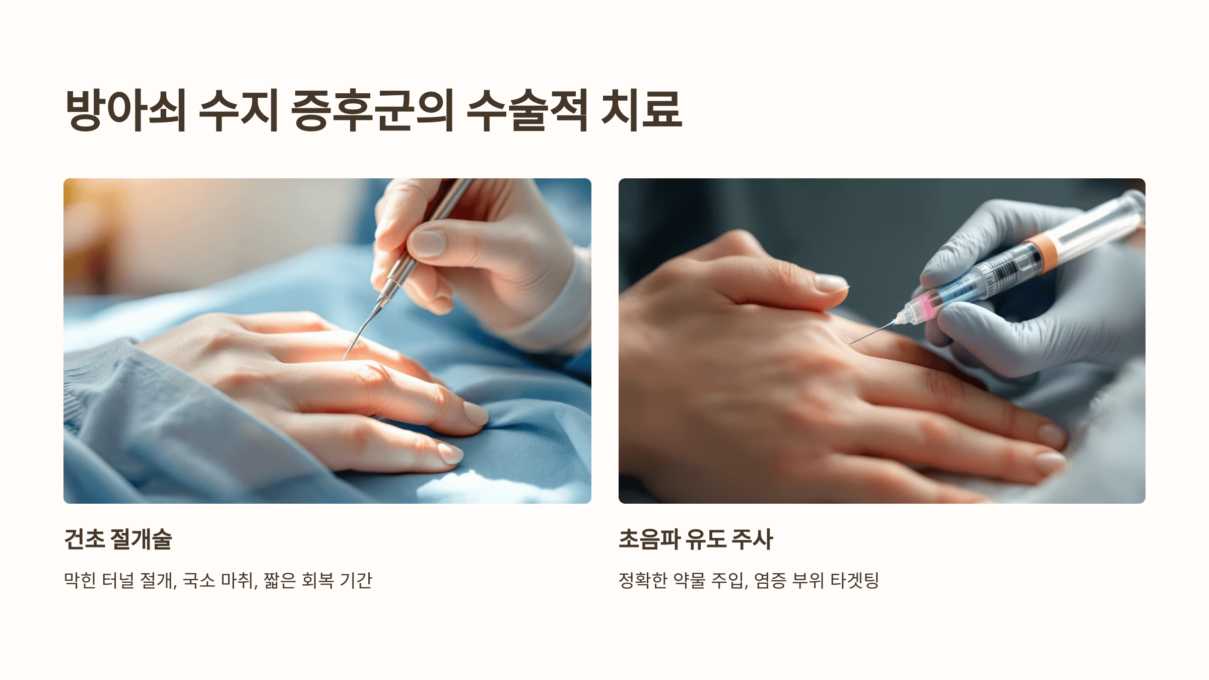 방아쇠 수지 증후군 관련된 사진입니다.