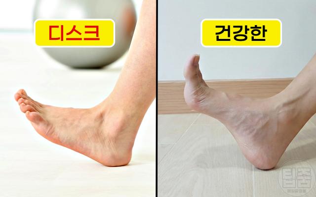 허리디스크 추간판탈출증 전조증상 발에 힘이 안들어가요